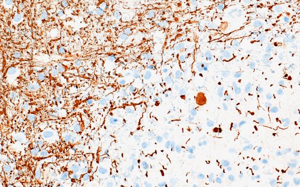 17H2 Vasculitis (Case 17) NF 40x 1