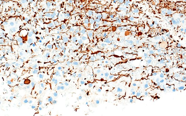 17H3 Vasculitis (Case 17) NF 40x 2