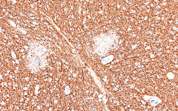 17H4 Vasculitis (Case 17) NF 20x 3A