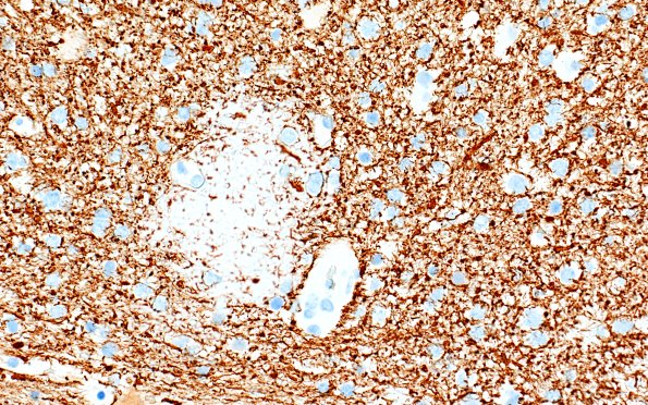 17H5 Vasculitis (Case 17) NF 40x 4