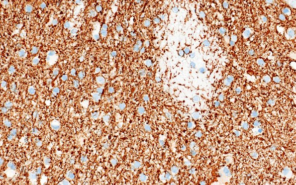 17H6 Vasculitis (Case 17) NF 40x 3