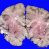 1A1 Vasculitis, granulomatous (Case 1) _9