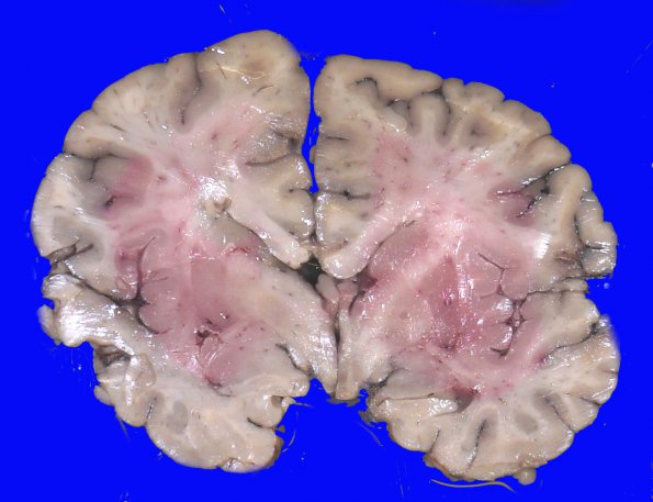 1A1 Vasculitis, granulomatous (Case 1) _9