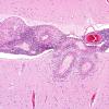 1B2 Vasculitis, granulomatous (Case 1) H&E 2