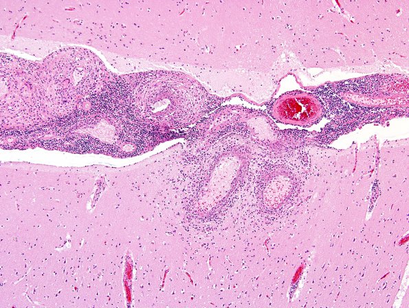 1B2 Vasculitis, granulomatous (Case 1) H&E 2