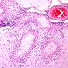 1B3 Vasculitis, granulomatous (Case 10) H&E 1