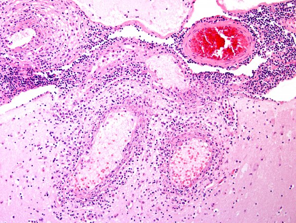 1B3 Vasculitis, granulomatous (Case 10) H&E 1