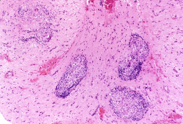 1B4 Vasculitis, Granulomatous Angiitis (Case 1) 46