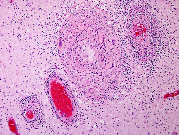 1B5 Vasculitis, granulomatous (Case 1) H&E 11.