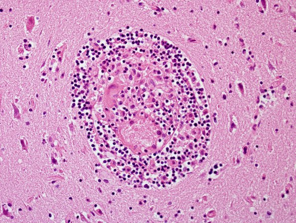 1B6 Vasculitis, granulomatous (Case 1) H&E 17.