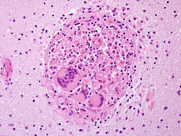 1B7 Vasculitis, granulomatous (Case 1) H&E 16