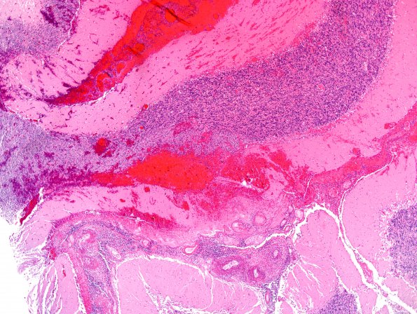 1B8 Vasculitis, granulomatous (Case 1) H&E 4X 4