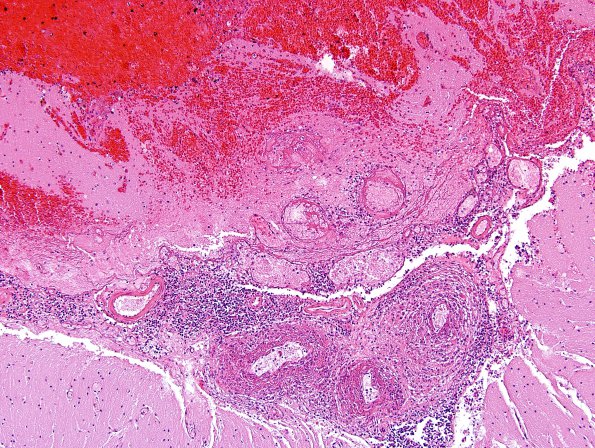 1B9 Vasculitis, granulomatous (Case 1) H&E 4X 3