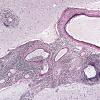 1C1 Vasculitis, granulomatous (Case 1) Elastin 5