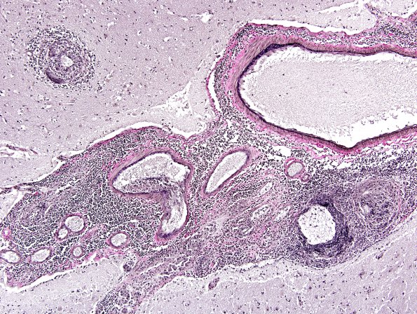 1C1 Vasculitis, granulomatous (Case 1) Elastin 5