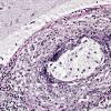 1C2 Vasculitis, granulomatous (Case 1) Elastin 2