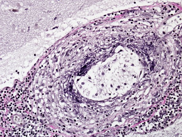 1C2 Vasculitis, granulomatous (Case 1) Elastin 2