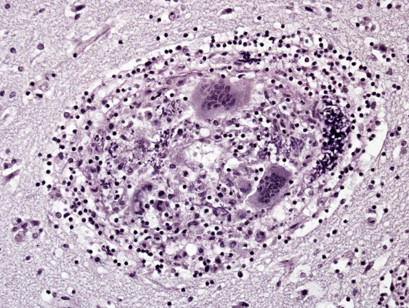 1C3 Vasculitis, granulomatous (Case 1) Elastin 1