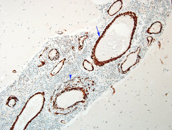 1D1 Vasculitis, granulomatous (Case 1) SMA 5 copy