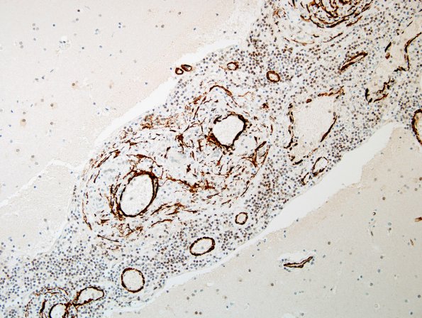 1D2 Vasculitis, granulomatous (Case 1) SMA 6