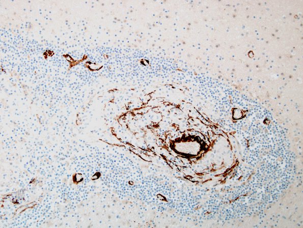 1D3 Vasculitis, granulomatous (Case 1) SMA 2