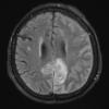 2A1 Granulomatous angiitis (Case 2) TIRM 1 - Copy