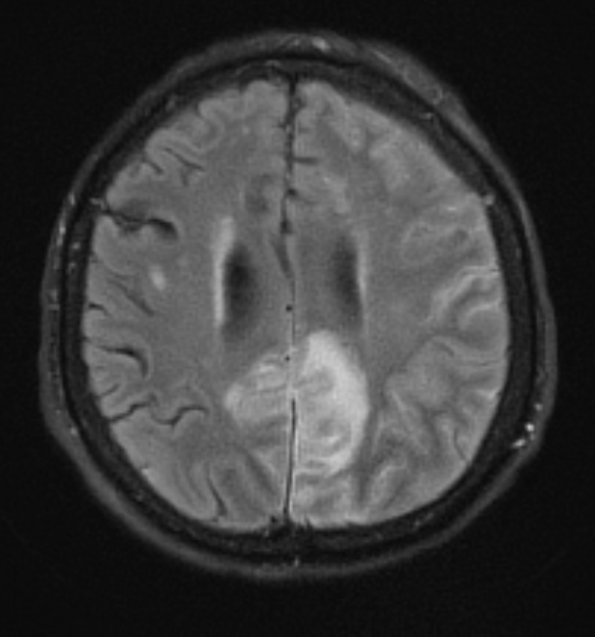 2A1 Granulomatous angiitis (Case 2) TIRM 1 - Copy