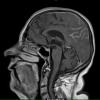 2A2 Granulomatous angiitis (Case 2) T1W 1 - Copy