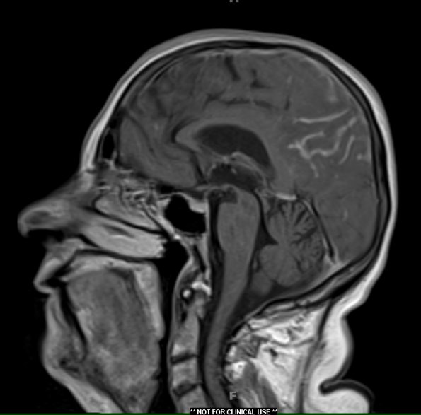 2A2 Granulomatous angiitis (Case 2) T1W 1 - Copy