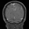 2A3 Granulomatous angiitis (Case 2) T1W 2 - Copy