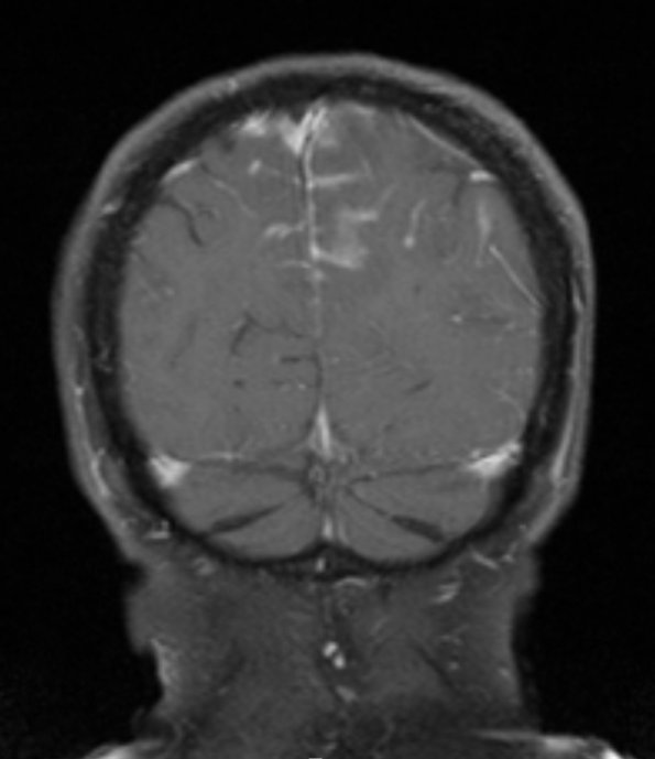 2A3 Granulomatous angiitis (Case 2) T1W 2 - Copy