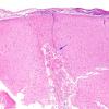 2B1 Granulomatous angiitis (Case 2) H&E 15 copy