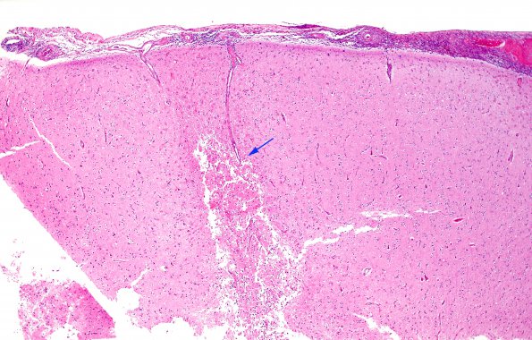 2B1 Granulomatous angiitis (Case 2) H&E 15 copy