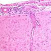 2B2 Granulomatous angiitis (Case 2) H&E 14