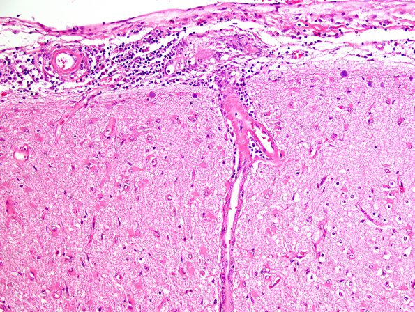 2B2 Granulomatous angiitis (Case 2) H&E 14