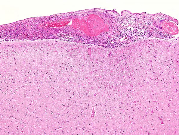 2B3 Granulomatous angiitis (Case 2) H&E 10X 1