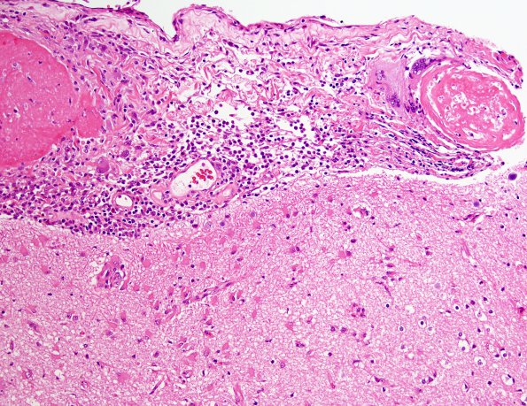 2B4 Granulomatous angiitis (Case 2) H&E 2.