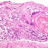 2B5 Granulomatous angiitis (Case 2) H&E 3