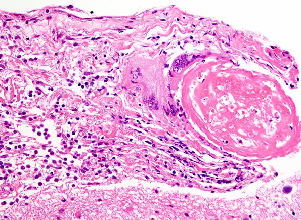 2B5 Granulomatous angiitis (Case 2) H&E 3