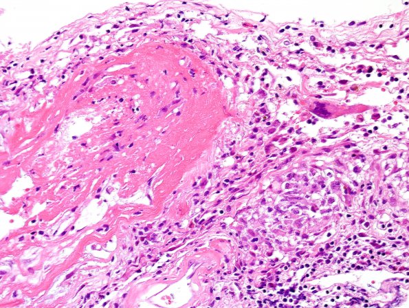 2B6 Granulomatous angiitis (Case 2) H&E 3