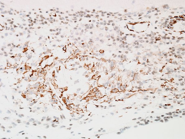 2C1 Granulomatous angiitis (Case 2) SMA 2