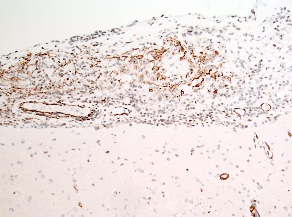 2C2 Granulomatous angiitis (Case 2) SMA 3