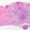 3A1Angiitis, granulomatous, CNS only (Case 3) H&E 11