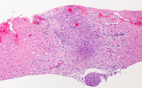 3A1Angiitis, granulomatous, CNS only (Case 3) H&E 11