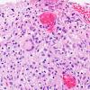 3A2 Angiitis, granulomatous, CNS only (Case 3) H&E 8