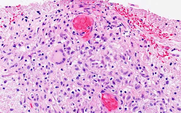 3A2 Angiitis, granulomatous, CNS only (Case 3) H&E 8