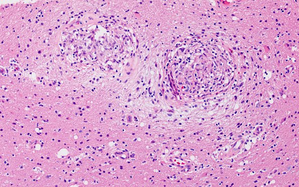 3A3 Angiitis, granulomatous, CNS only (Case 3) H&E 7