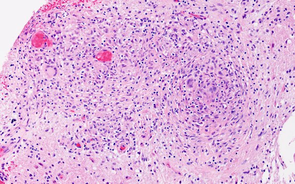 3B1 Angiitis, granulomatous, CNS only (Case 3) H&E 10