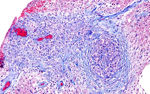 3B2 Angiitis, granulomatous, CNS only (Case 3) Trichrome 6