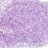 3B3A Angiitis, granulomatous, CNS only (Case 3) EVGNC 2